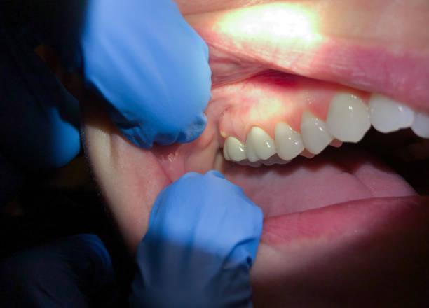 Best Cracked Tooth Emergency Dentist  in Watonga, OK